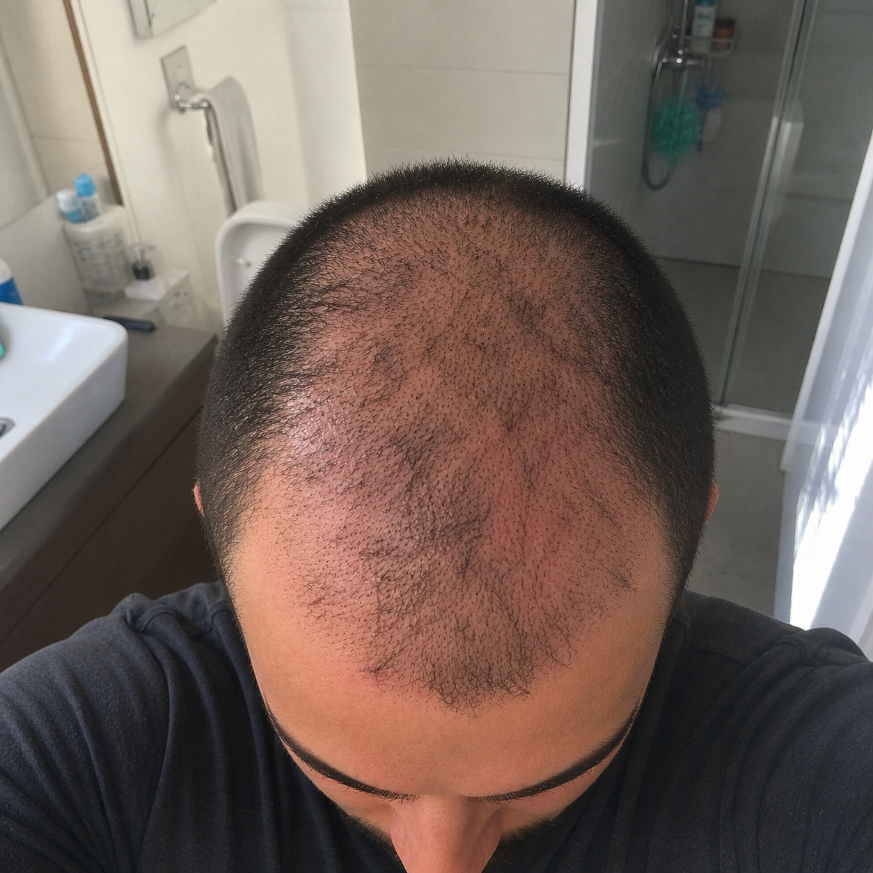 Hair transplant progress month 2