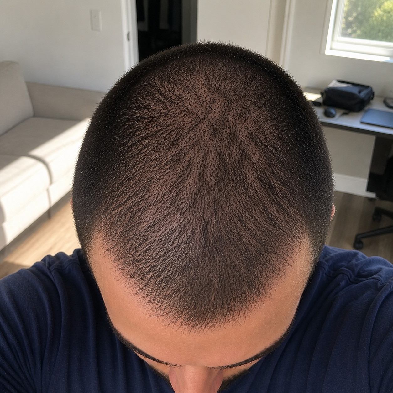 Hair transplant progress month 6 — visible growth