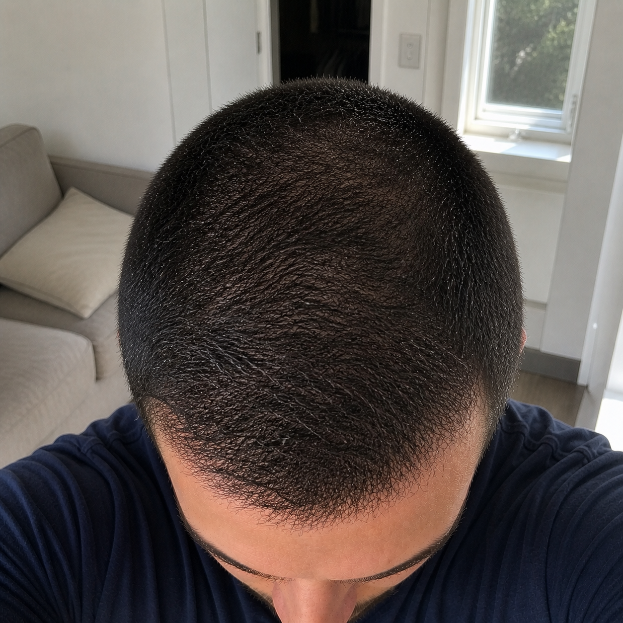 Hair transplant progress month 12 — near final result