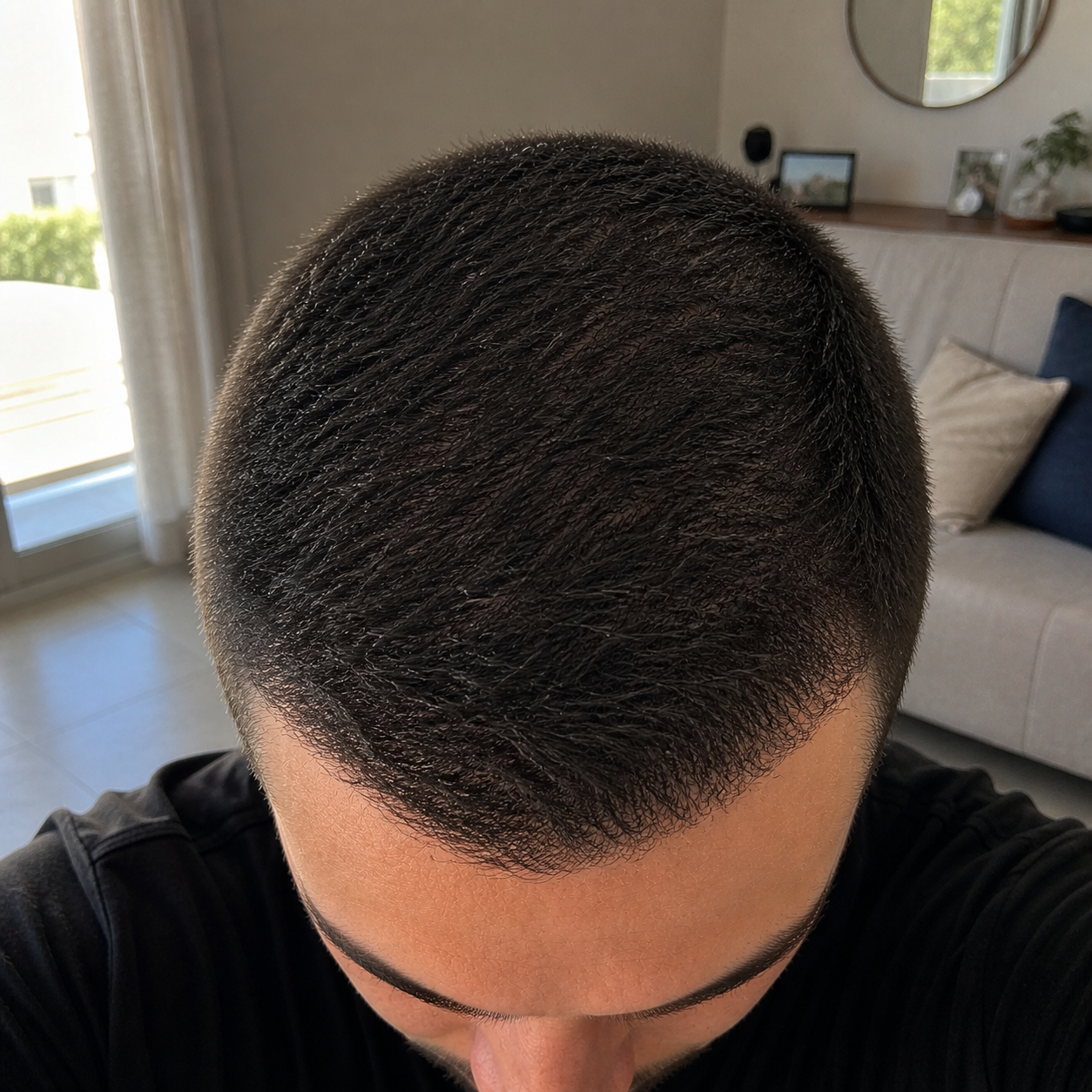 Hair transplant final result month 18 — full coverage