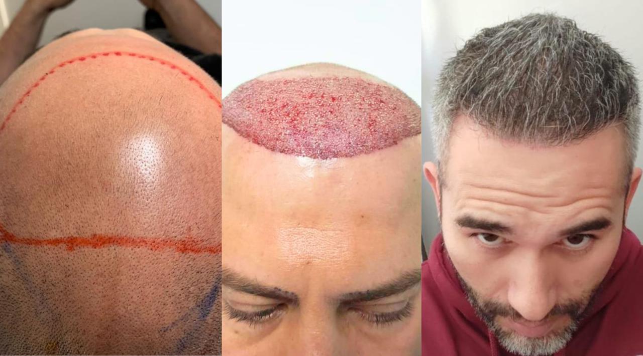 Hair transplant transformation - Crown restoration Tijuana clinic